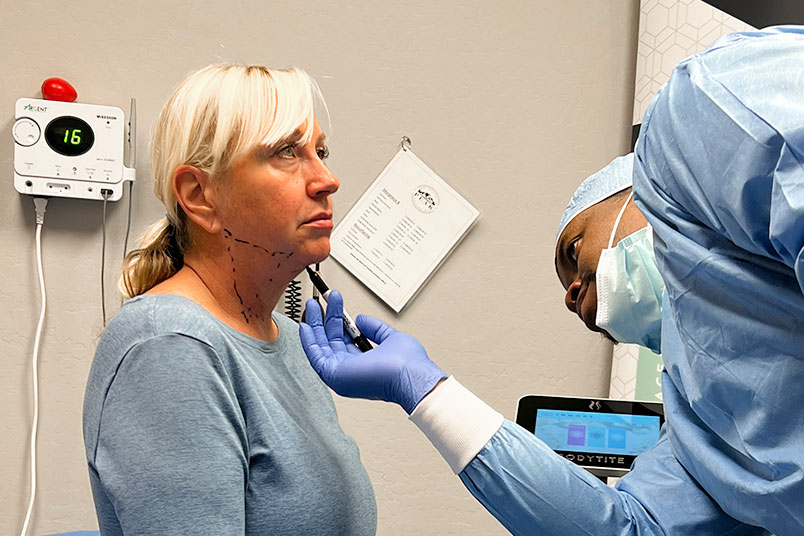 Peak Dermatology provider using the BodyTite device to treat a patient's face